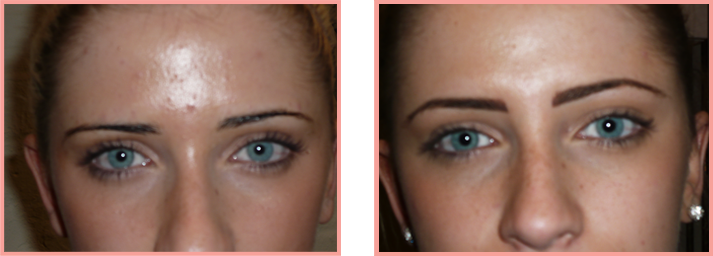 brows-before-after